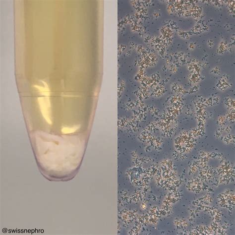 film on pee|Sediment In Urine: White, Amorphous, Visible, Brown, .